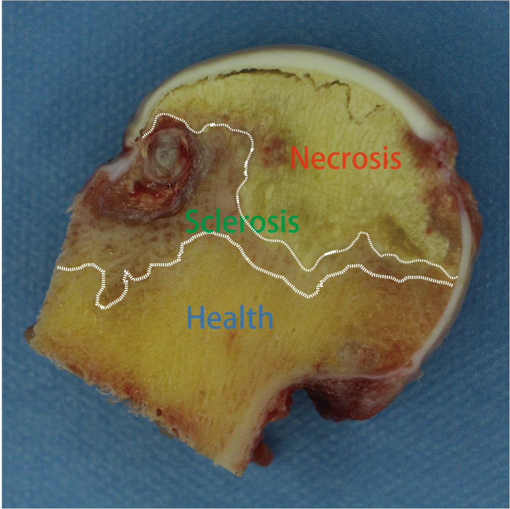 Macroscopic features of osteonecrosis of the femoral head (ONFH). Cross-sectional macroscopic view of a femoral head specimen obtained during total hip arthroplasty, illustrating the distinct anatomical regions sampled for data-independent acquisition (DIA)-based proteomic analysis: yellowish-white necrotic bone, gray sclerotic bone, and yellow healthy bone.